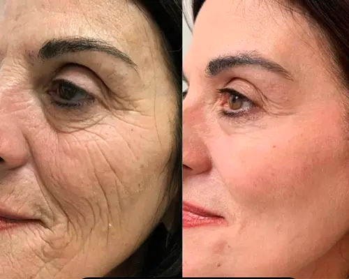 Antes e Depois de aplicação de Fenol