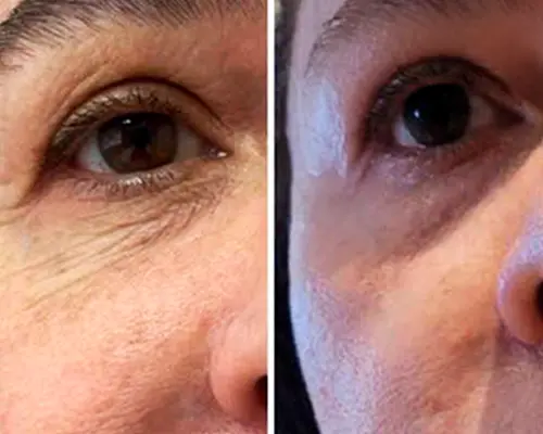 Antes e depois da minha técnica Revive Skin